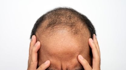 غذای ما و ریزش مو !
